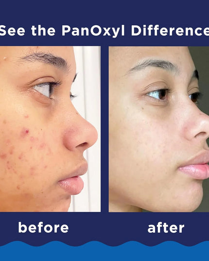 PanOxyl Acne Foaming Wash